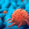 Como detectar o câncer e seus sintomas ainda cedo